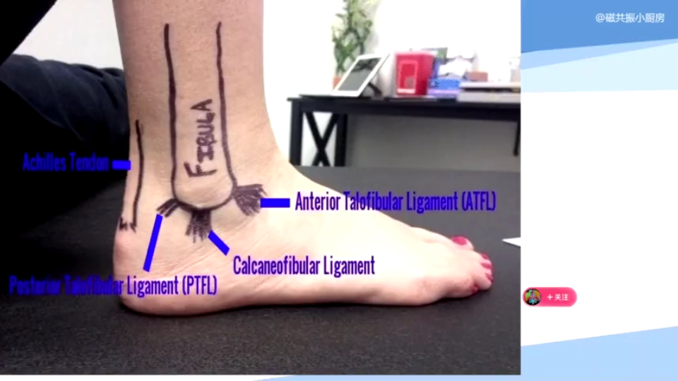 足踝关节解剖及磁共振表现第二节(外侧副韧带),简单明了,一看就会哦哔哩哔哩bilibili
