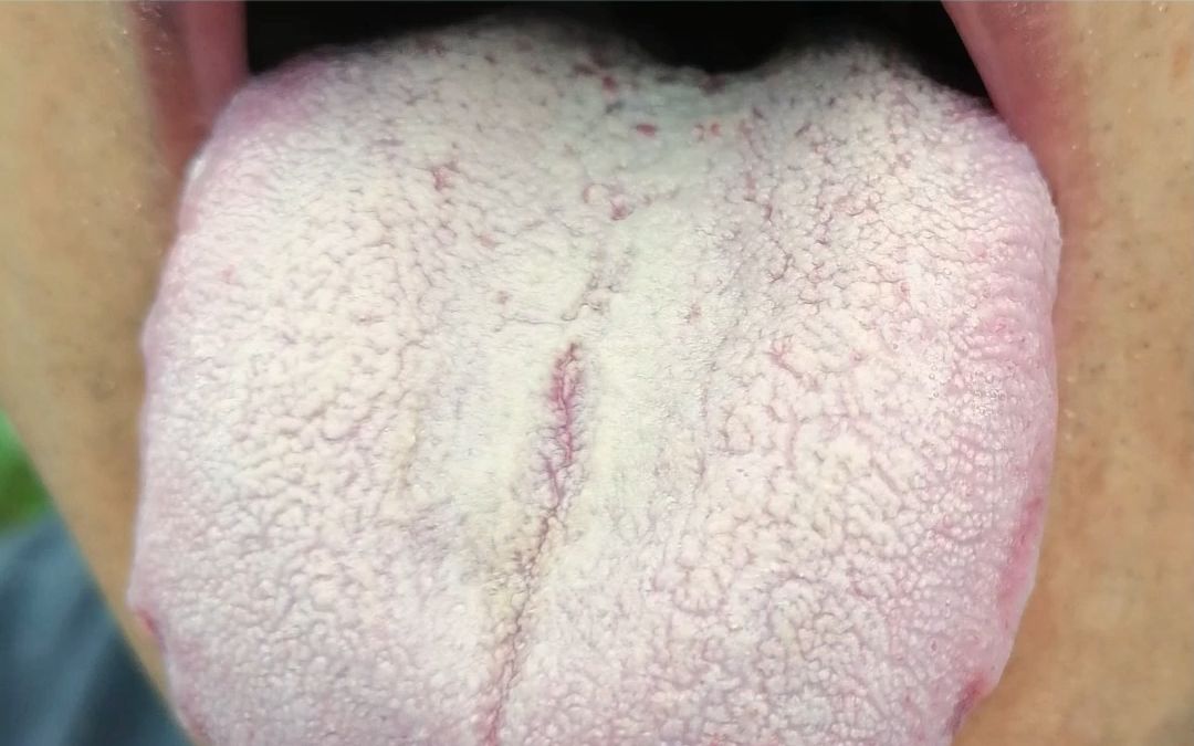 肝胆湿热的舌苔图片
