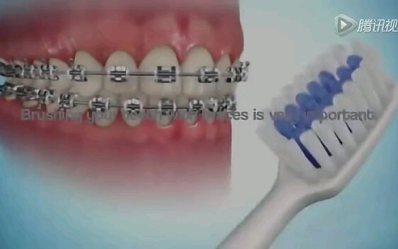 正畸时如何刷牙、使用牙缝刷及牙线【牙套之家】哔哩哔哩bilibili