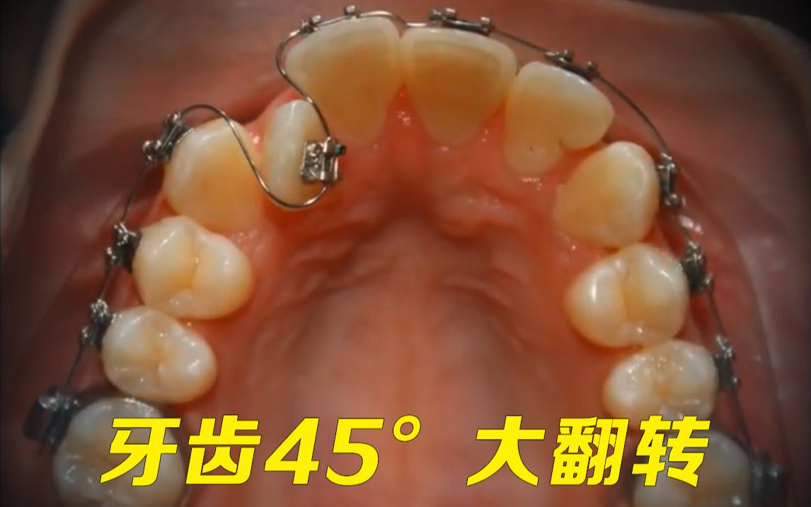 牙齿矫正!切牙45°大扭转_哔哩哔哩_bilibili