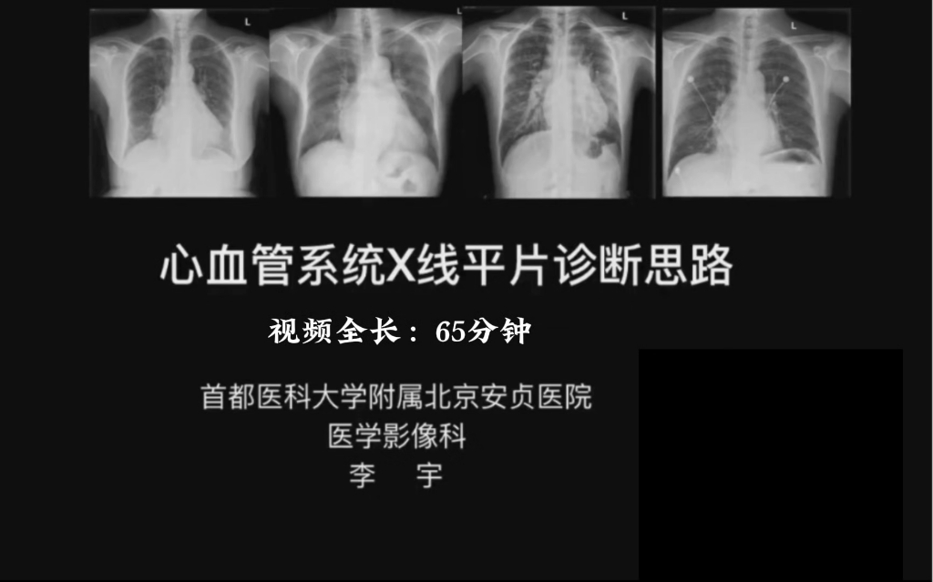 心血管影像系列课【共32讲】02:心血管系统X线平片诊断思路(李宇)哔哩哔哩bilibili