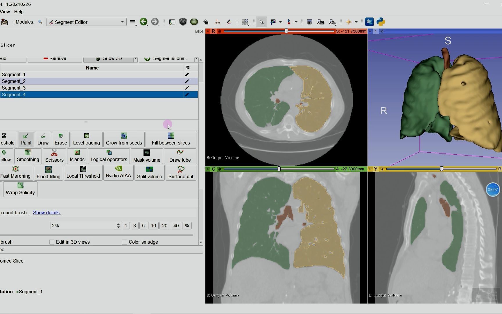 3D Slicer开源软件对肺部CT标注-加班辣-CT读片-哔哩哔哩视频