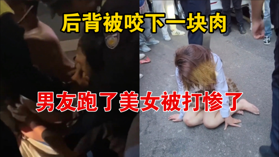 [图]女子路怒与情侣发生冲突，男子为保护女友后背被咬下一块肉，知情人：男子后续已去医院打破伤风