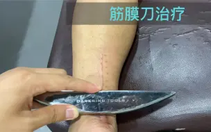 Descargar video: 跟腱断裂修复术后康复(回归运动)