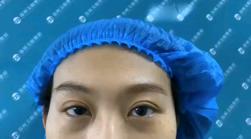 术式右眼切开双眼皮 后1/2双眼皮睑板增