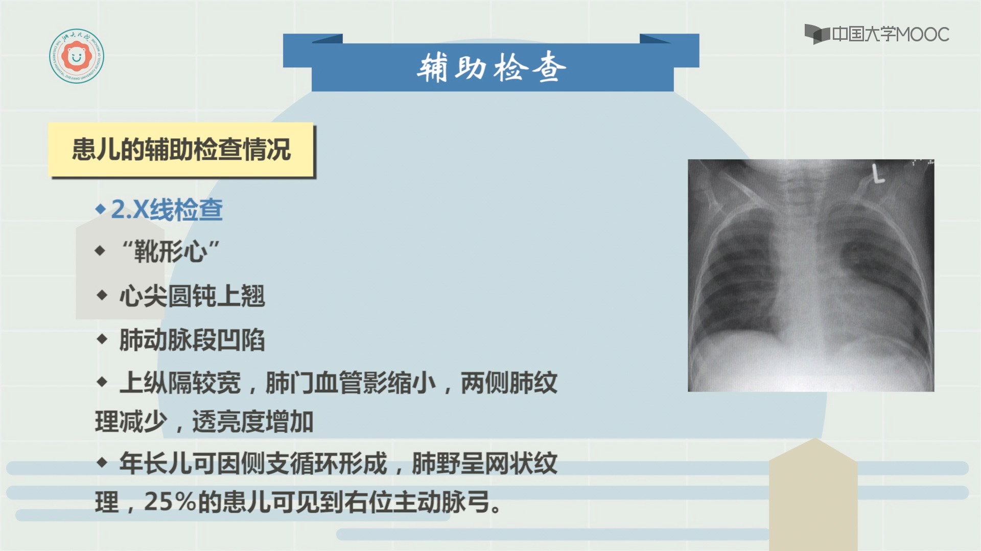 5.1]--法洛四联症的病理生理,临床表现,缺氧发作的处理