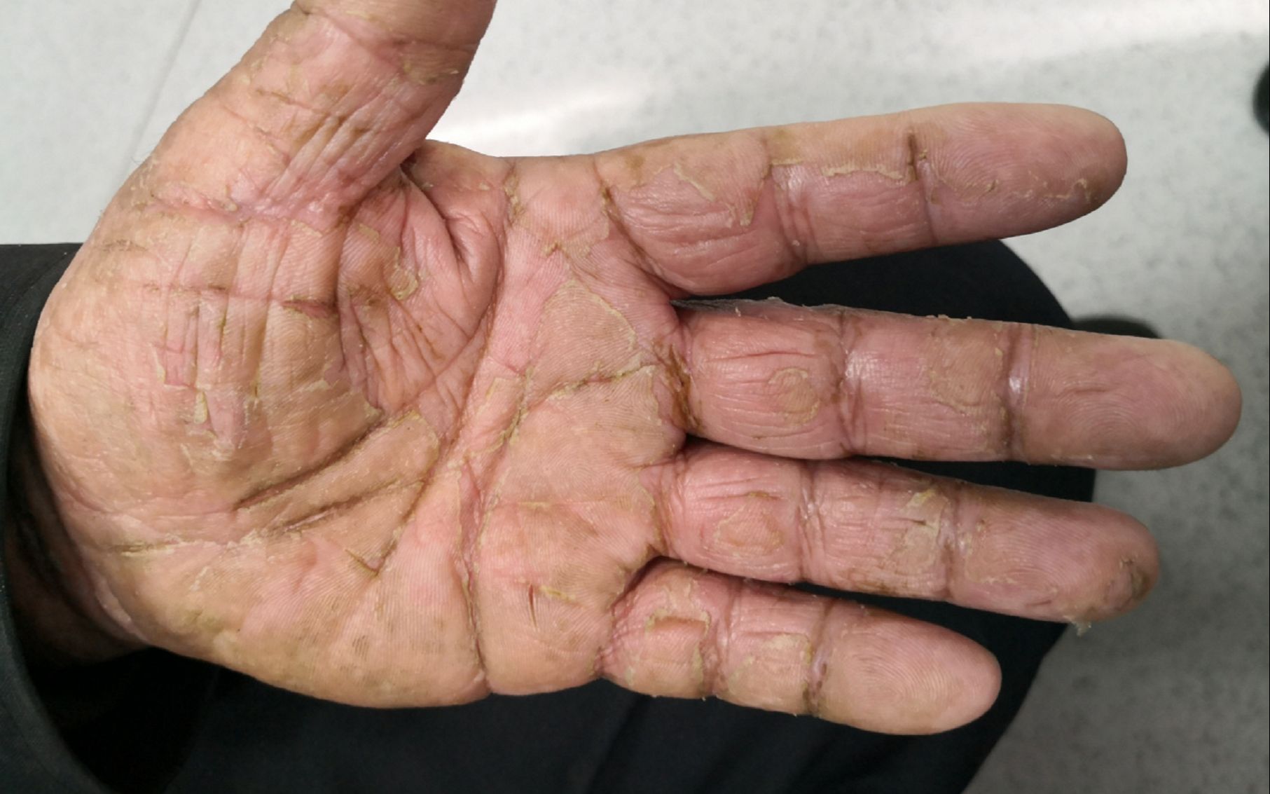 自用皲裂膏分享!3天远离手掌干裂爆皮!不多花一分冤枉钱!