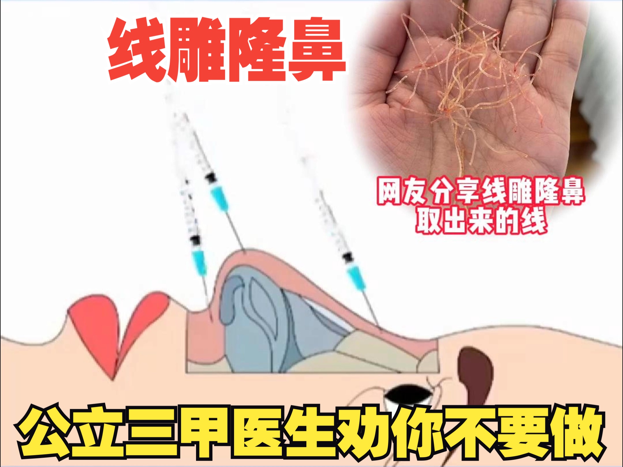 线雕隆鼻动画演示!公立三甲医生劝你不要做