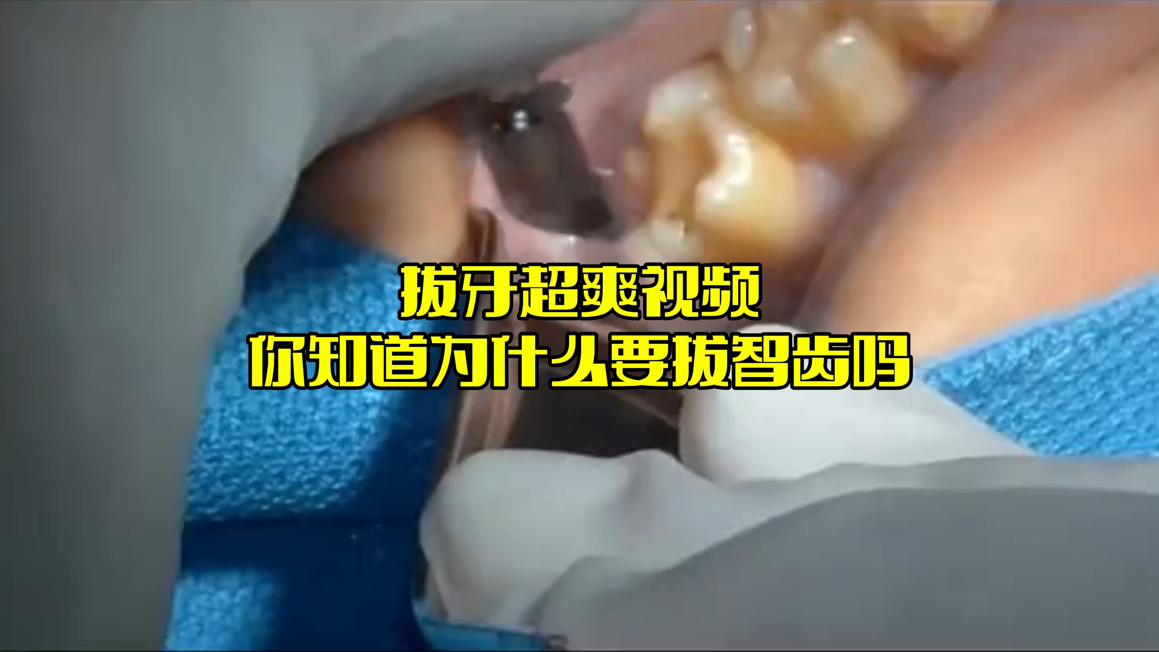 简简单单拔个牙 你知道为什么老拔智齿吗
