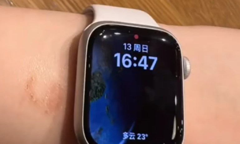 女子戴AppleWatch睡觉手腕被烫伤.多人戴苹果AppleWatch手腕被烫伤起泡.苹果回应:过敏反应.哔哩哔哩bilibili