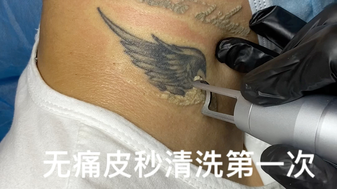 深圳洗纹身正规医院图片