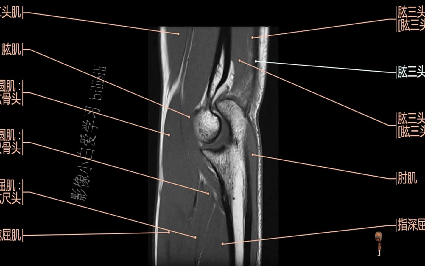 6.关节MRI解剖图谱肘关节MRI解剖哔哩哔哩bilibili