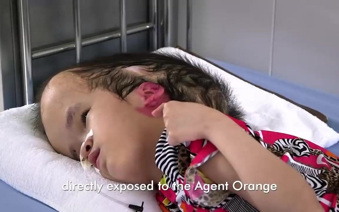 橙剂 美国人民送给越南人民的"礼物" 与战争