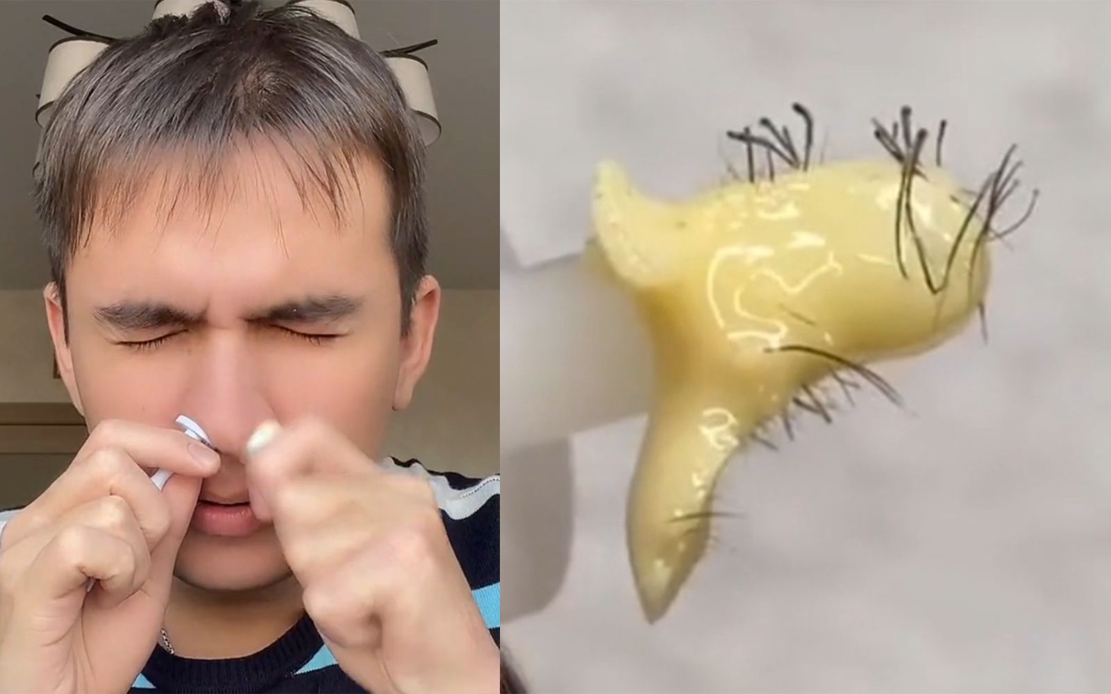 网红蜜蜡脱鼻毛当真有效?小伙不信,直到他.