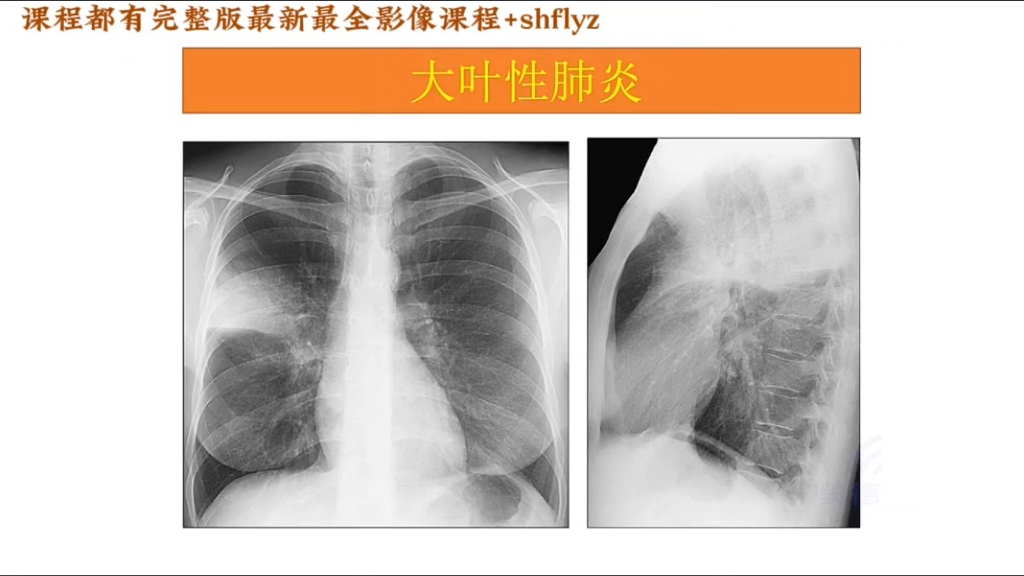 大叶性肺炎dr图片图片