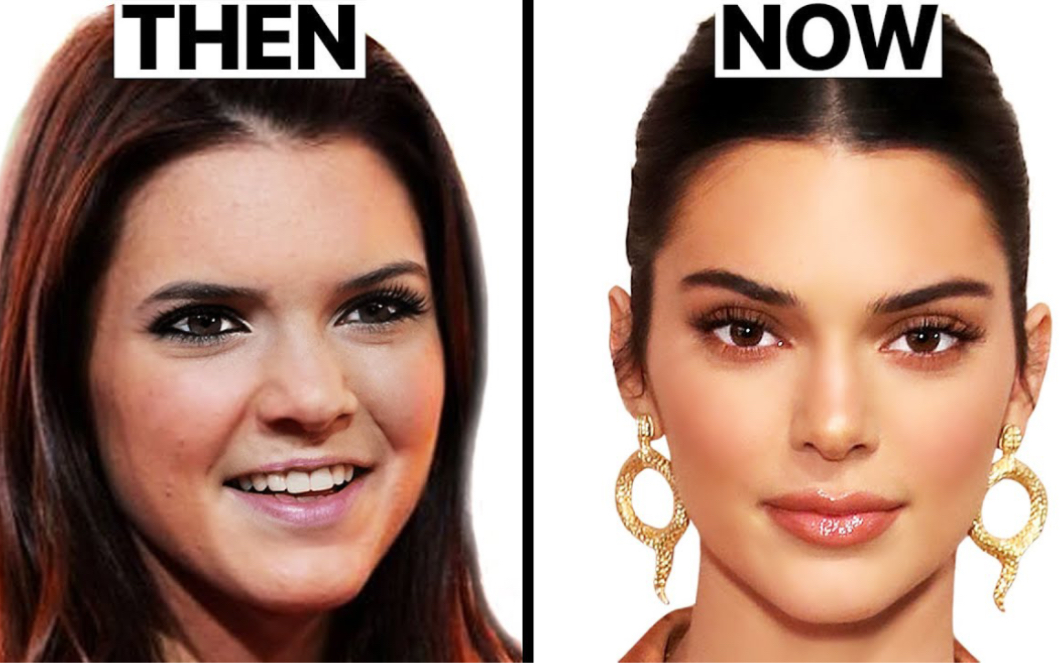 kendall jenner|肯豆的脸发生了什么|整容手术分析