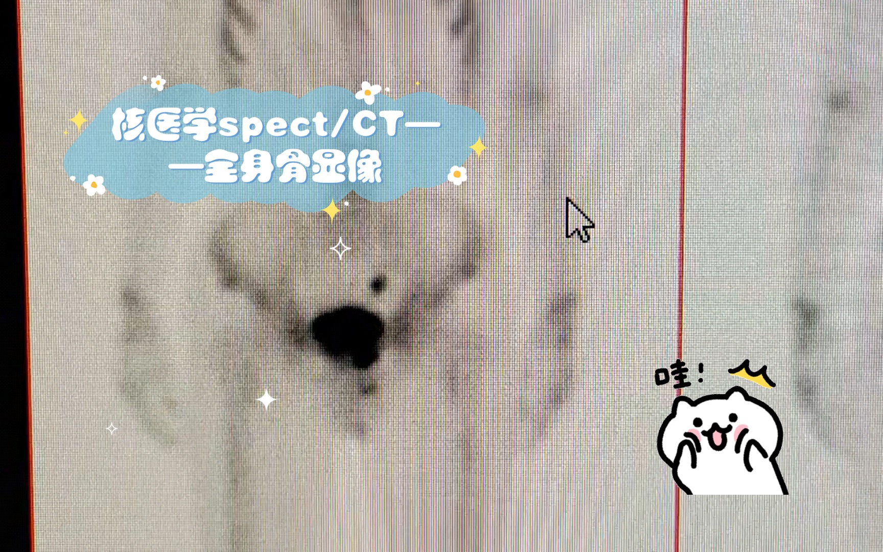 核医学spect/CT——全身骨显像哔哩哔哩bilibili