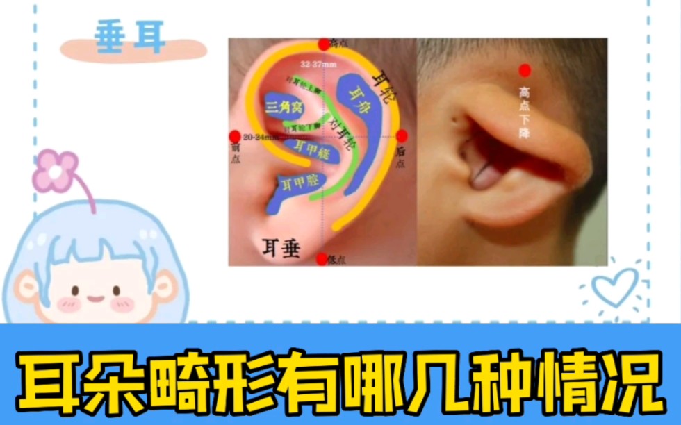 耳朵畸形有哪几种情况呢?哔哩哔哩bilibili