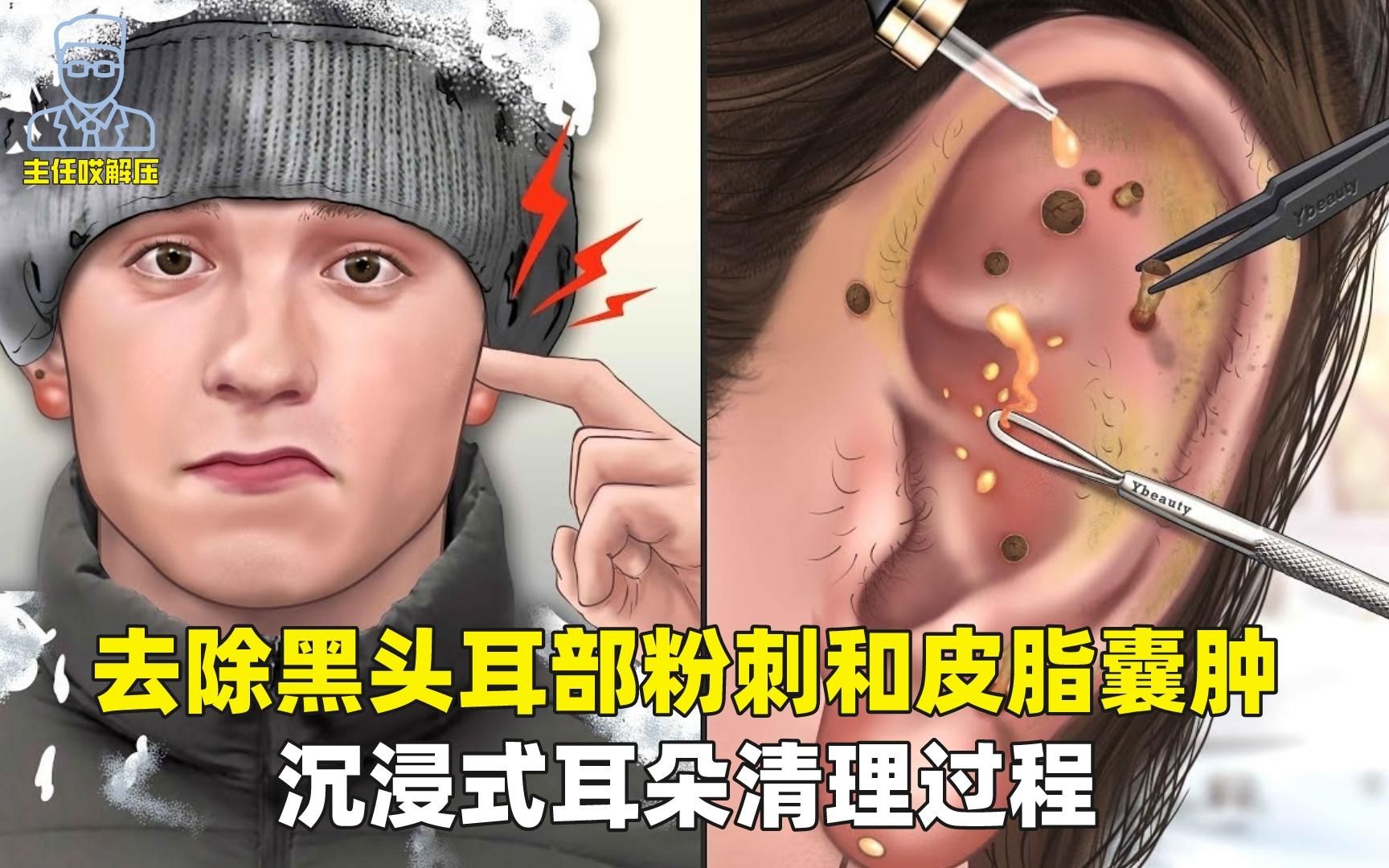 解压动画,去除耳部黑头粉刺和皮脂囊肿,沉浸式清理耳朵过程