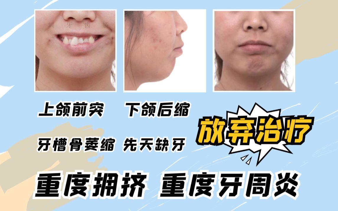 "重度拥挤 牙槽骨萎缩 上颌前突 下颌后缩 先天缺牙"