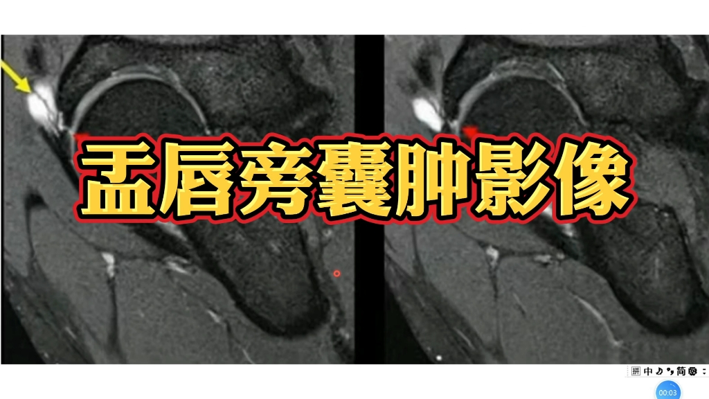 盂唇撕裂伴盂唇旁囊肿形成MRI图像分享,收藏学习!哔哩哔哩bilibili