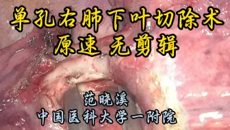 单孔胸腔镜右肺下叶切除术 原速未剪辑 范晓溪教授供稿