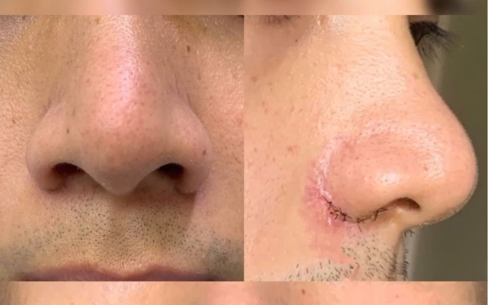鼻翼缩小(鼻翼大造成的鼻孔大而不美观)术后7天,疤痕后期会淡化到接近
