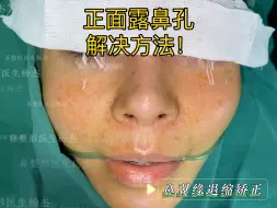 Download Video: 鼻翼缘退缩矫正，改善正面露鼻孔！