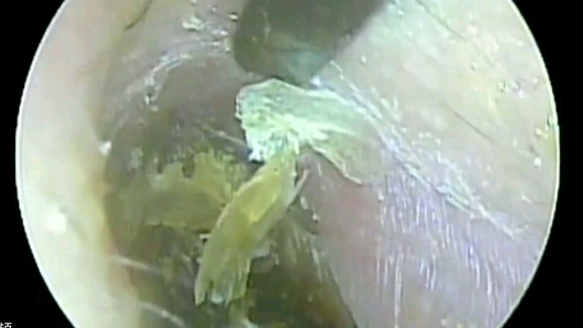 这种耳结是由于客人不当采耳(用棉签桶而导致的耳结)#可视采耳
