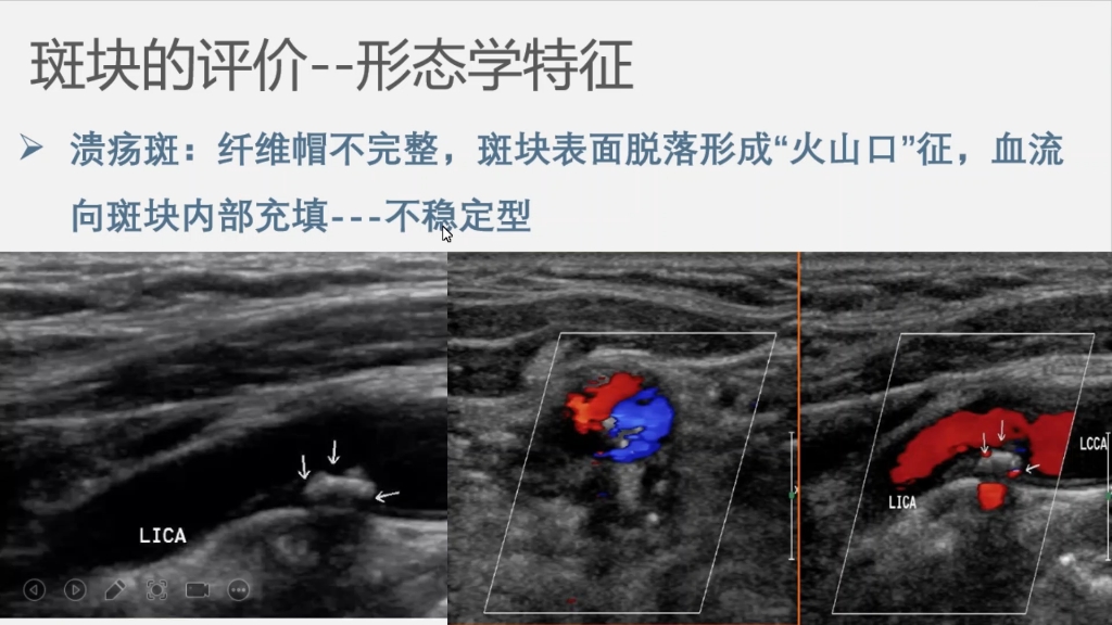 [图]血管超声:颈部血管超声解剖及扫查手法演示