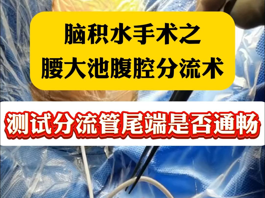 腰大池腹腔分流手术哔哩哔哩bilibili