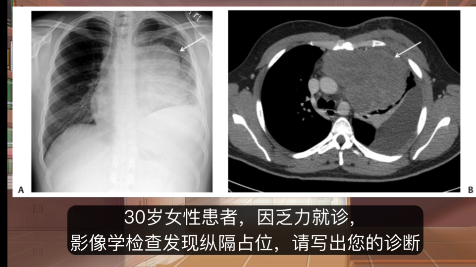 30岁女性因乏力就诊,影像学检查发现纵隔占位,这就要考虑淋巴瘤的可能.哔哩哔哩bilibili