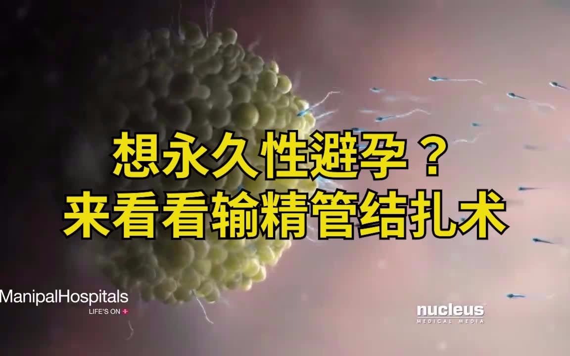 【医学科普】想永久性避孕?来看看输精管结扎术哔哩哔哩bilibili