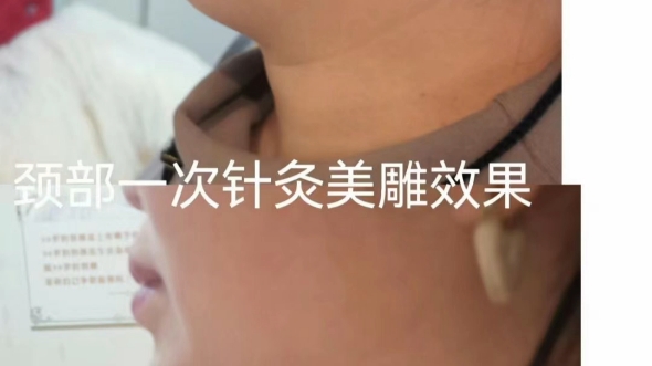 美康针灸美雕去颈纹一次项目