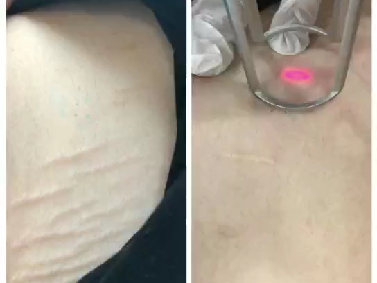 腹部妊娠纹治疗,妊娠纹是纤维断裂后的皮下疤痕,表皮很薄,皮下缺失