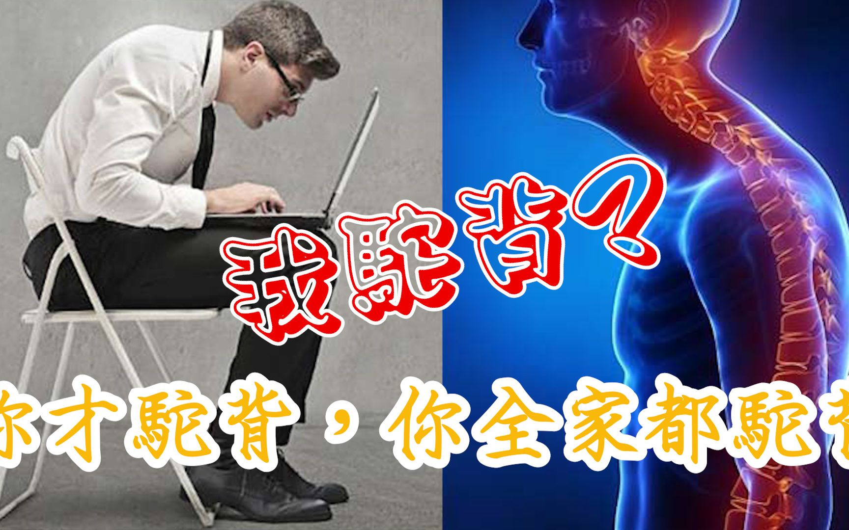 驼背其实有救,不要放弃治疗.哔哩哔哩bilibili