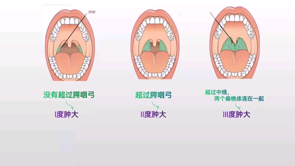 儿童扁桃体二度肿大,不一定是扁桃体发炎了.有可能是生理性肿大.哔哩哔哩bilibili