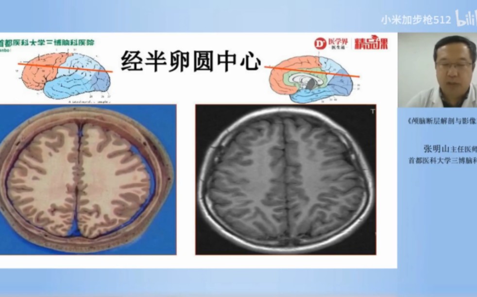 [图]颅脑断层解剖难记？影像对照来帮助