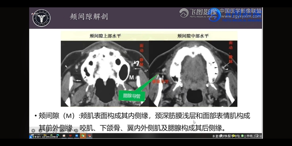 学习:侵删,病例一:粘表;病例二:腺样囊性癌ACC哔哩哔哩bilibili