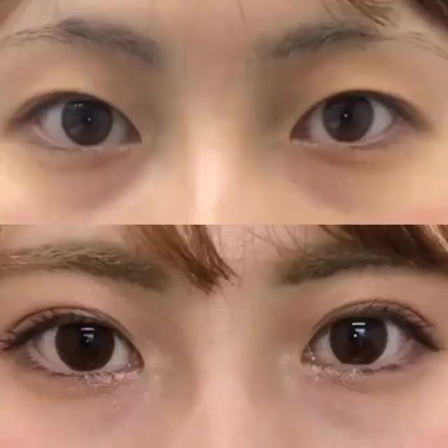 埋线双眼皮论内双的蜕变你们觉得做的如何呀