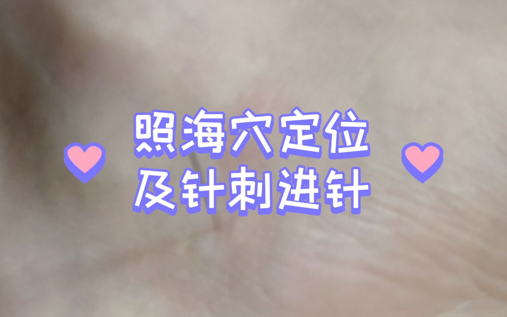 照海穴定位及针刺进针