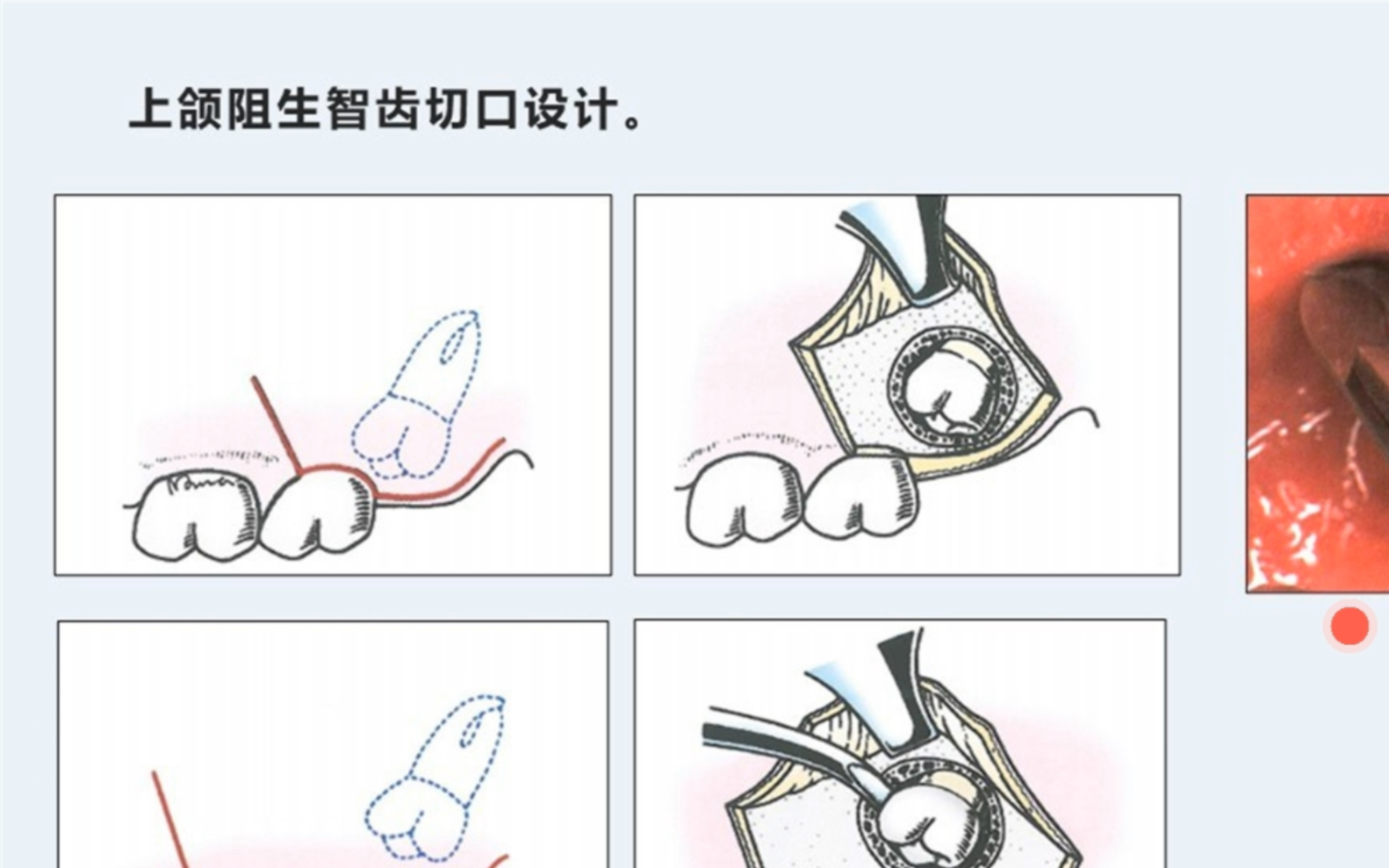 [图]刘洋 《见微知著 微创拔牙的剑与道》—上颌阻生牙拔除