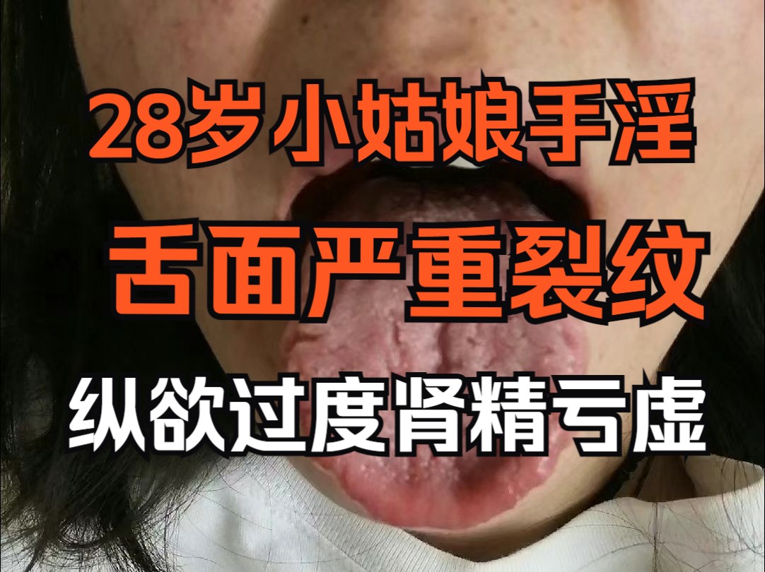 28岁小姑娘欲望大,爱看小电影纵欲过度,导致舌面严重裂纹!哔哩哔哩bilibili