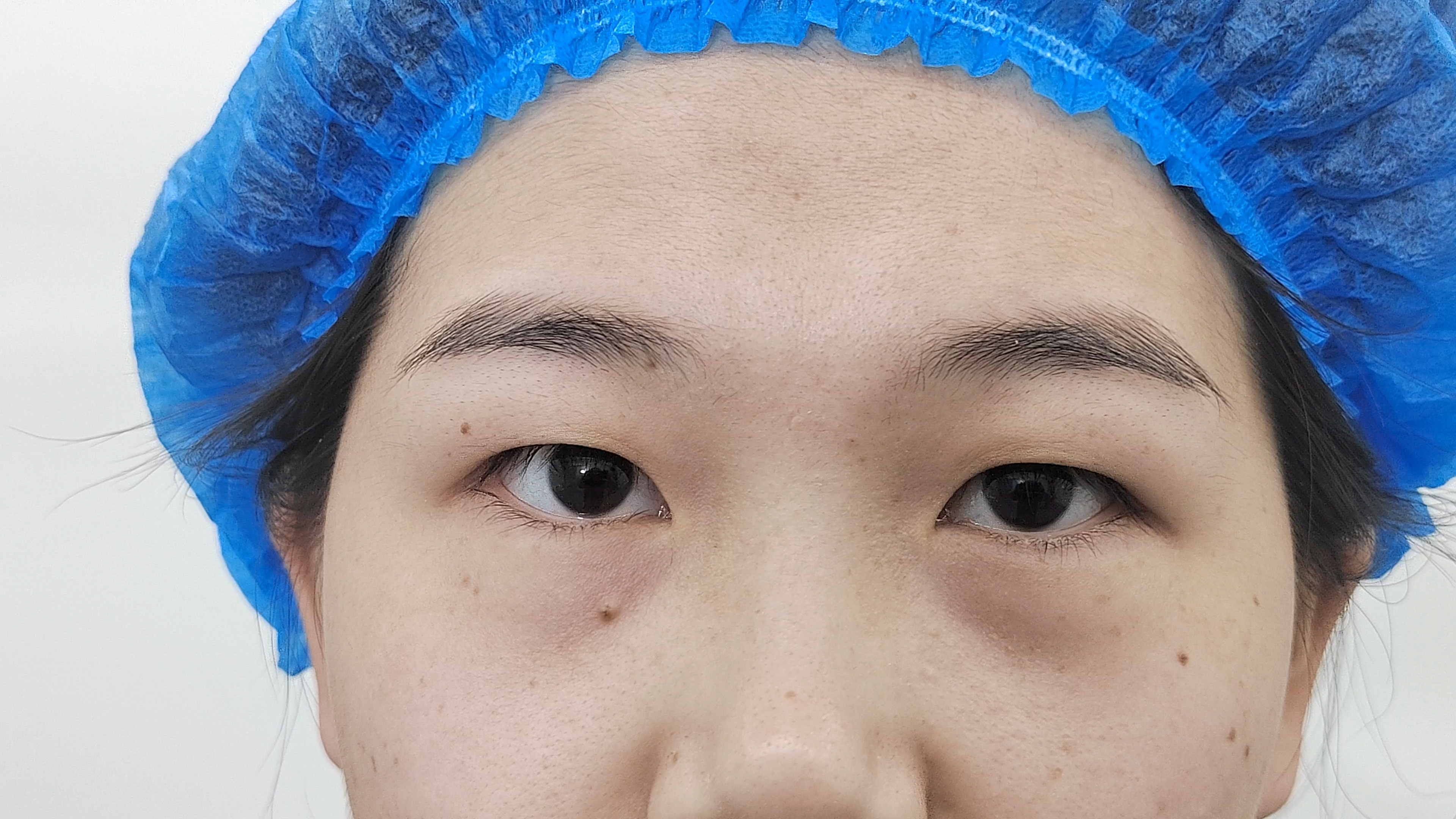 肿眼泡做双眼皮需要注意什么?