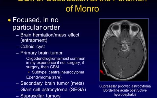 (脑积水影像学2:鉴别诊断)Imaging of Hydrocephalus Differential Diagnosis哔哩哔哩bilibili