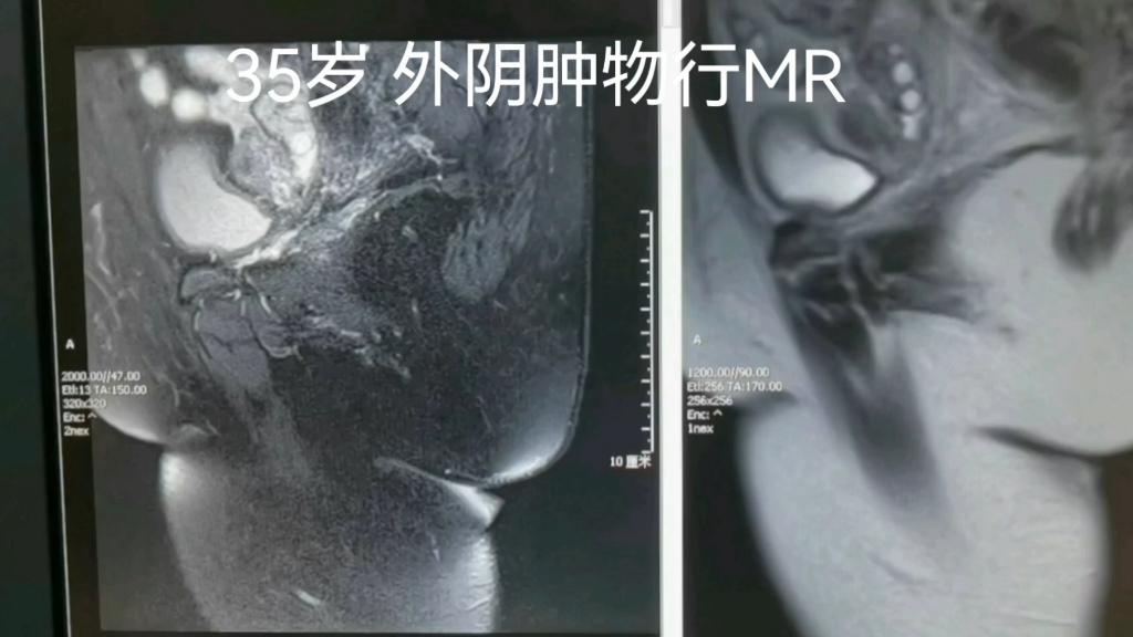 外阴肿物 病理【宫颈巨大息肉(纤维血管性)伴出血及表面溃疡形成】哔哩哔哩bilibili