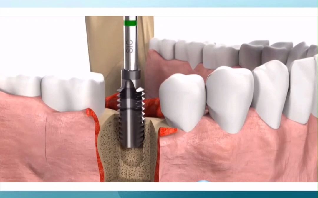 超详细动画演示种牙过程哔哩哔哩bilibili