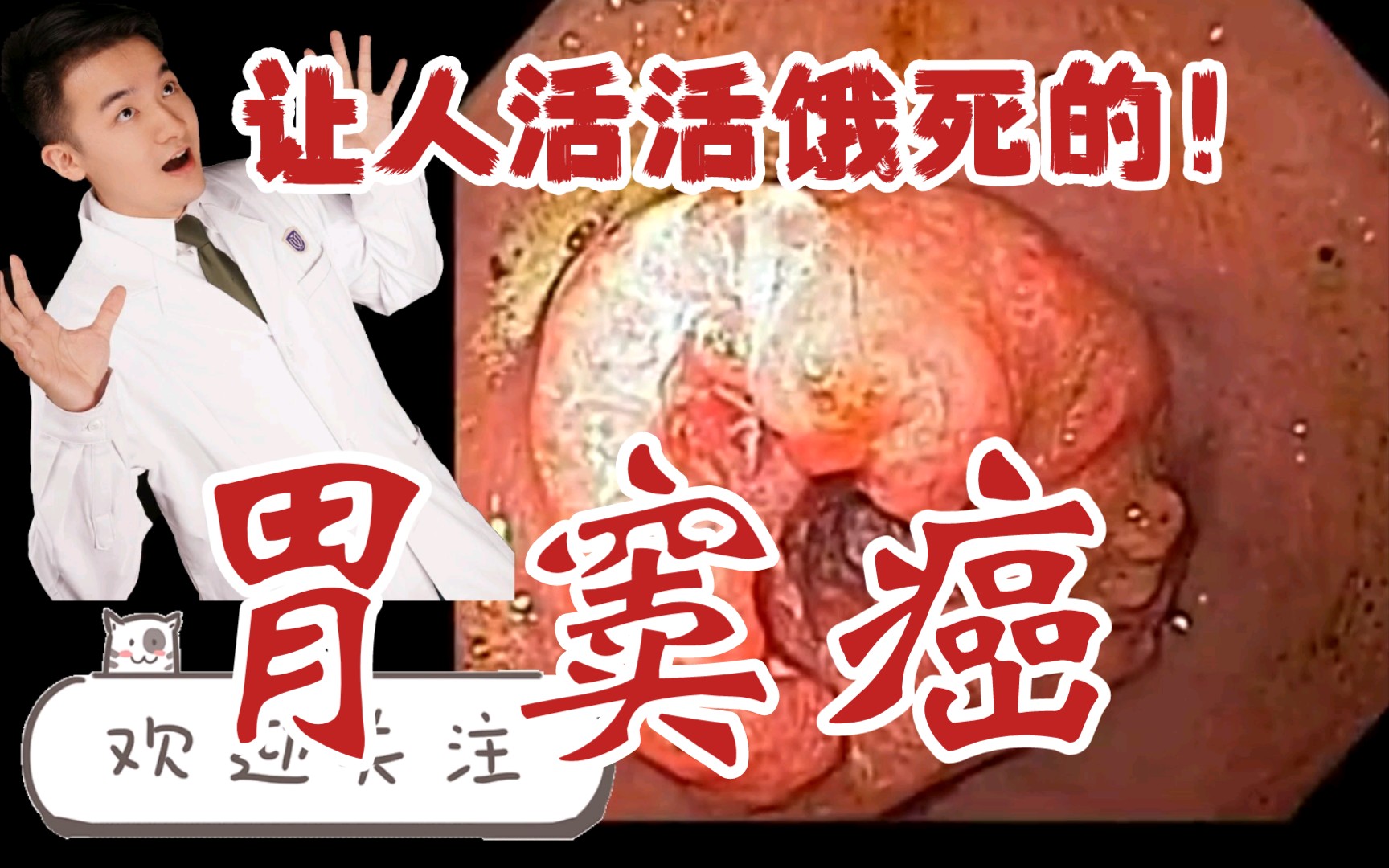 【医学柯南】让人活活饿死的胃窦癌长什么样子?哔哩哔哩bilibili