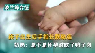 Download Video: 孩子出生后手指指蹼粘连，奶奶：是不是怀孕时吃了鸭子肉