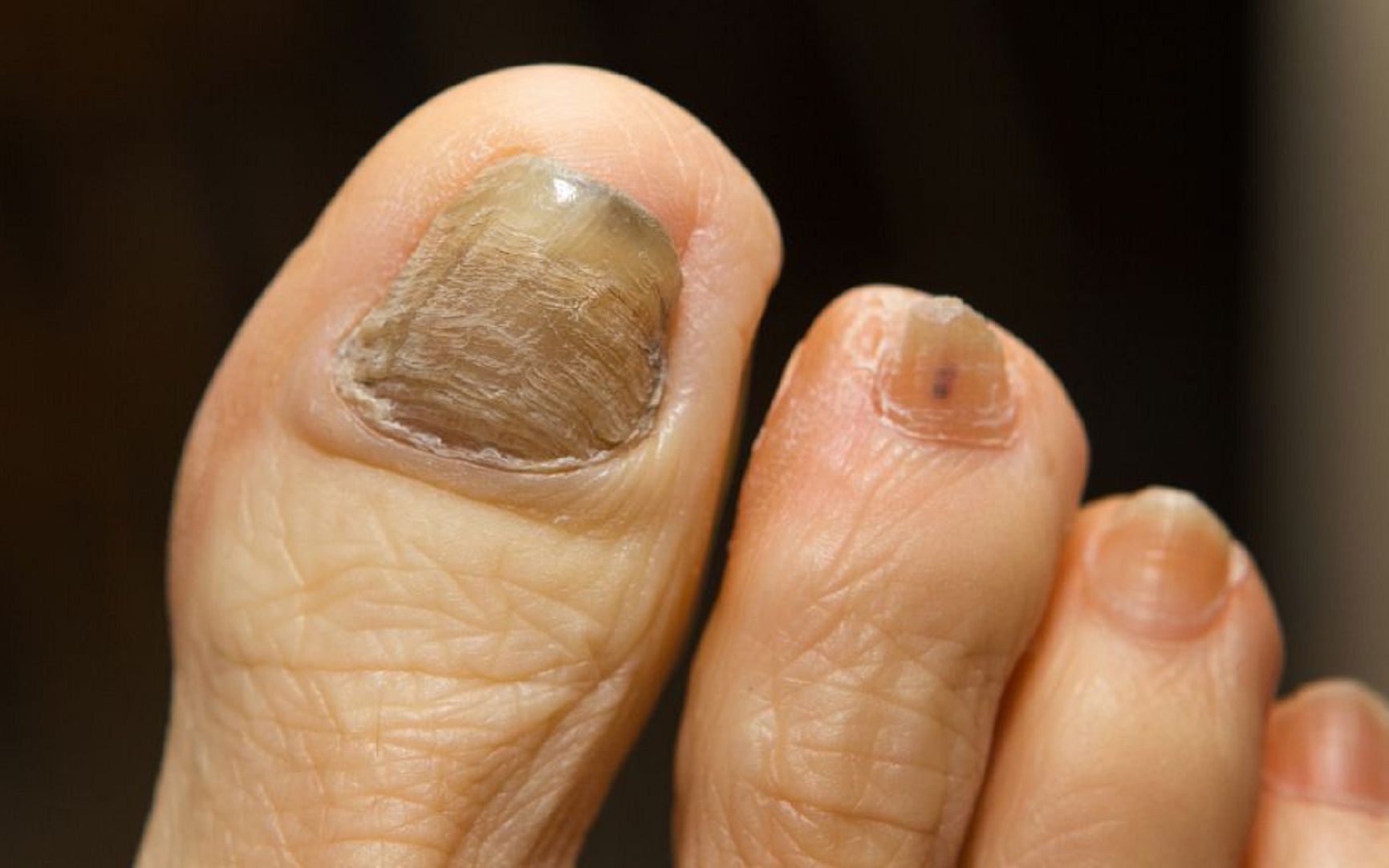 指甲增厚分层?过来人祛灰妙招分享!顽固灰指甲一次治好不反复!